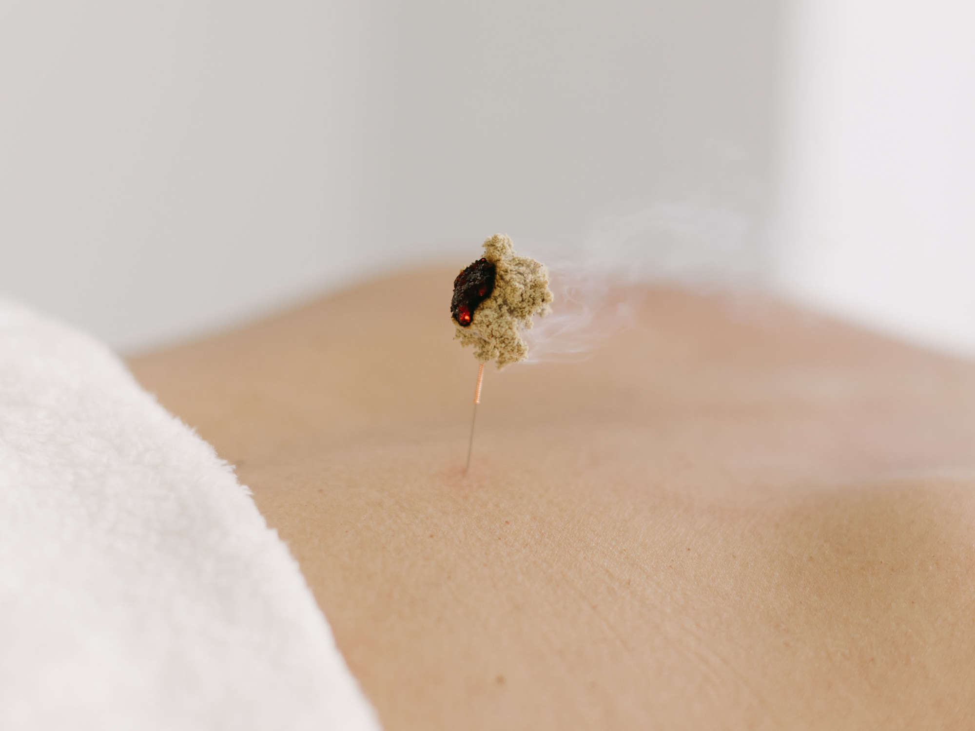 Moxibustion Treatment at Cherry Blossom Healing Arts